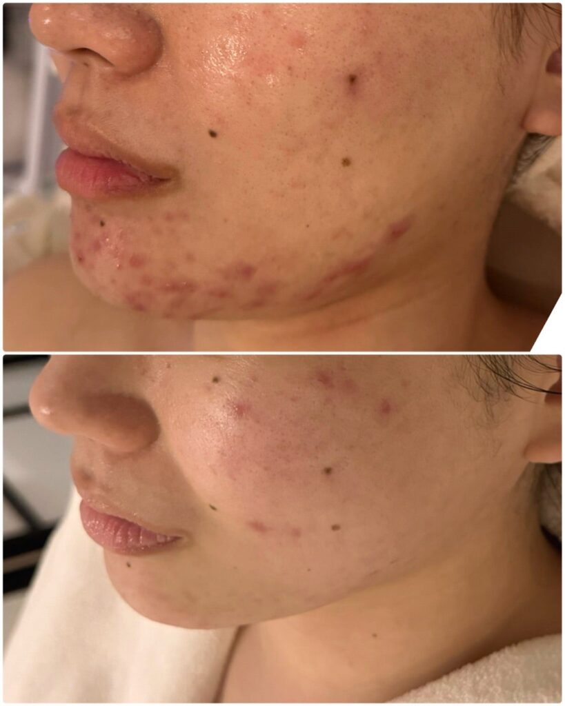 なぜ美容クリニックでニキビが悪化するのか？